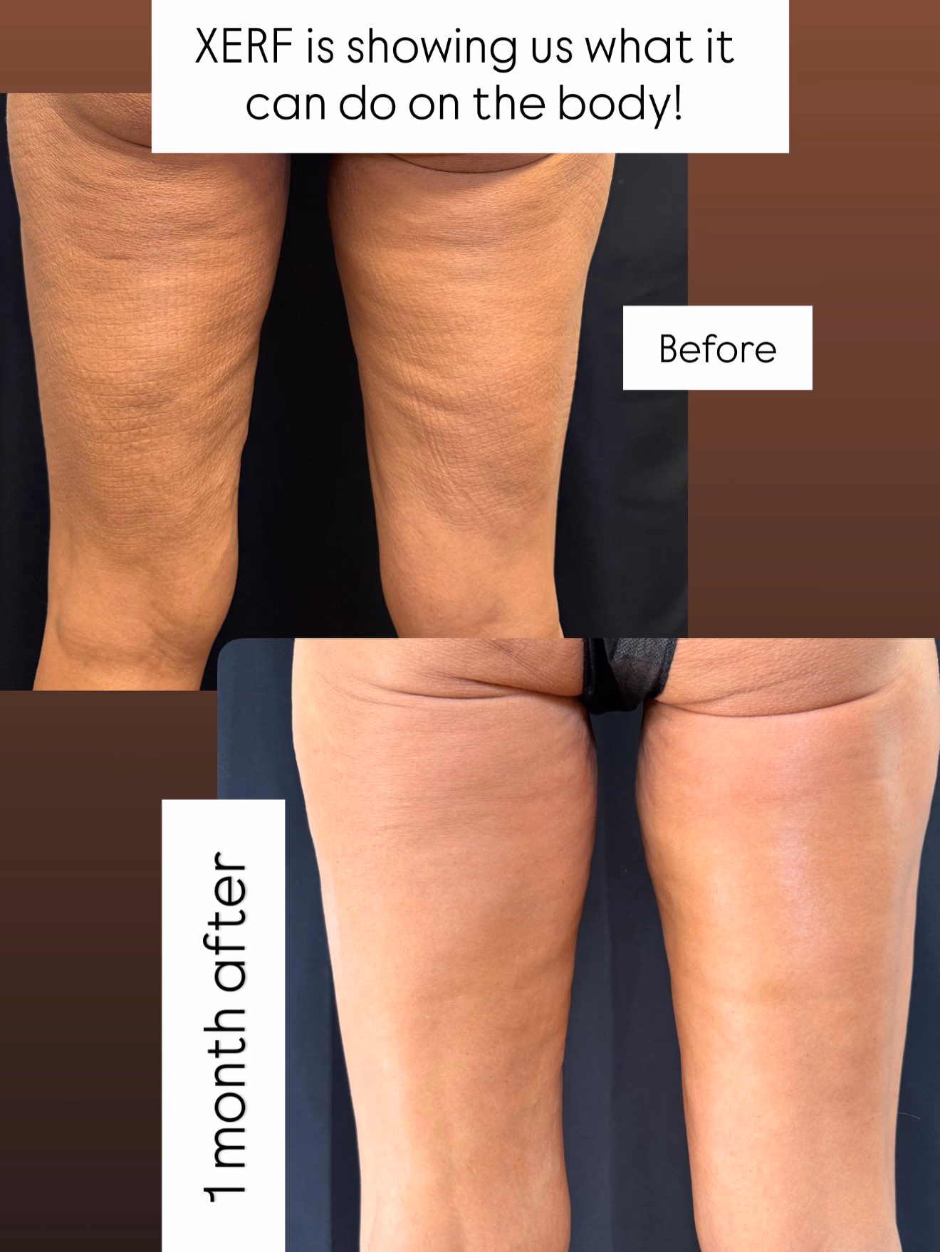 XERF™ radiofrequency body skin tightening treatment being performed at Dr Vahe Clinic, London