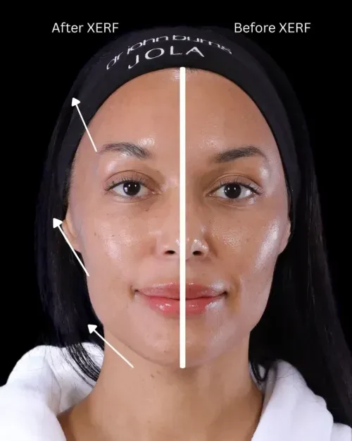 Before and after XERF™ Structural Skin Tightening at Dr Vahe Clinic, showing lifted brow, cheek and jawline on one half of the face